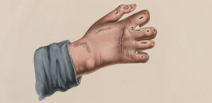 Leprosy Leprosy